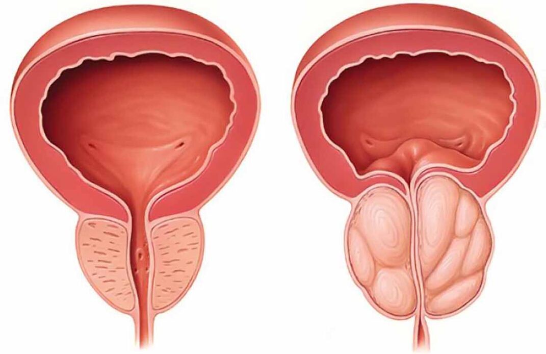 Normal prostate and prostate inflammation (chronic prostatitis)