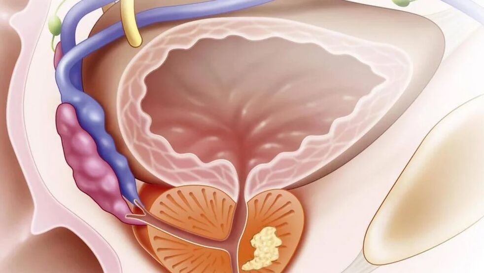 Nonbacterial chronic prostatitis