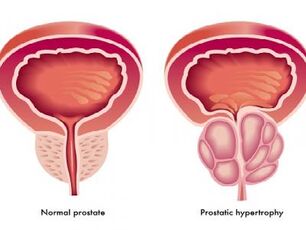 Normal and inflamed prostate