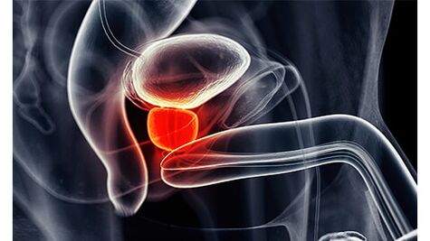 Inflammation of prostate glands