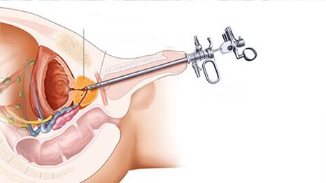Surgical treatment of prostatitis